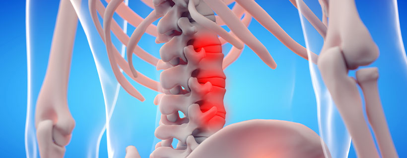 patient needing ankylosing spondylitis treatment in Monroeville