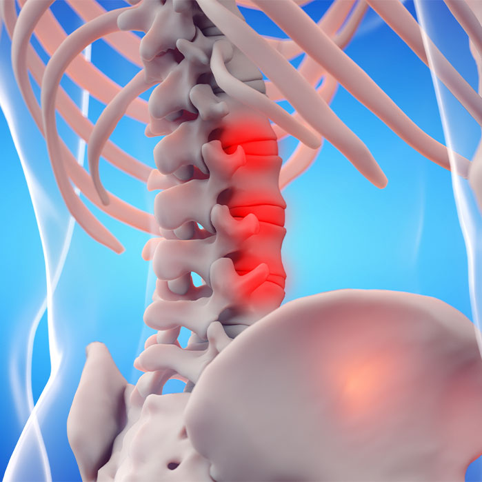 ankylosing spondylitis chiropractor in Monroeville, PA