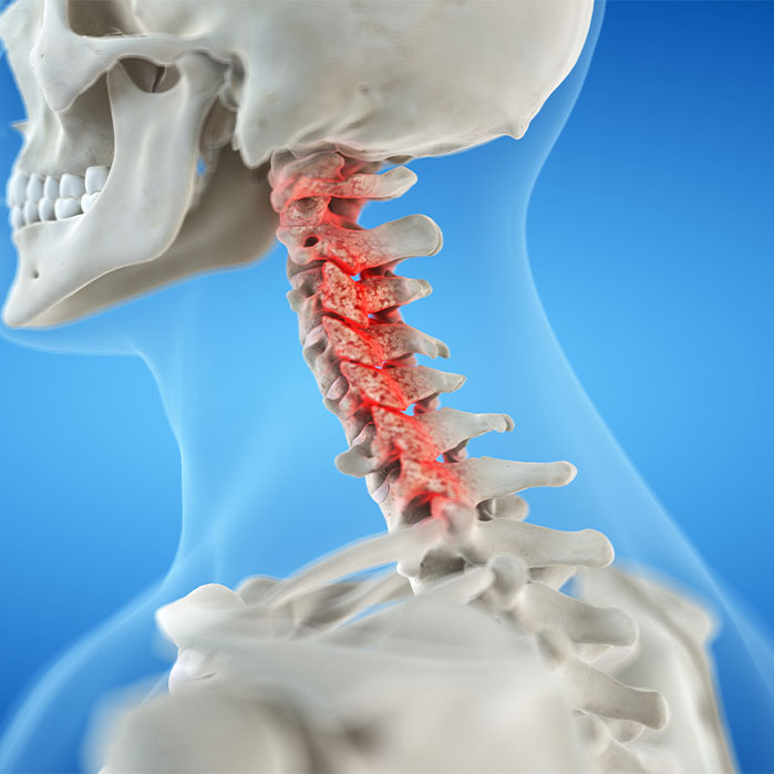bone spur treatment in Monroeville, PA