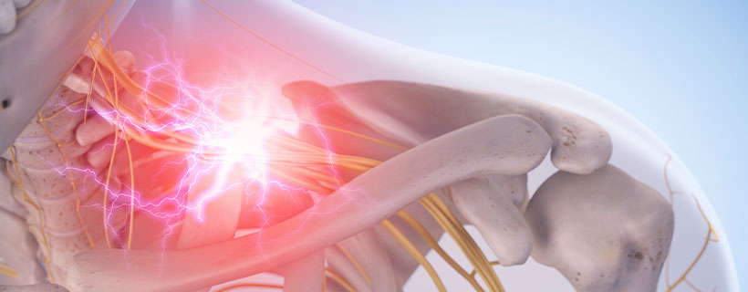 patient needing brachial plexus neuritis treatment in Monroeville