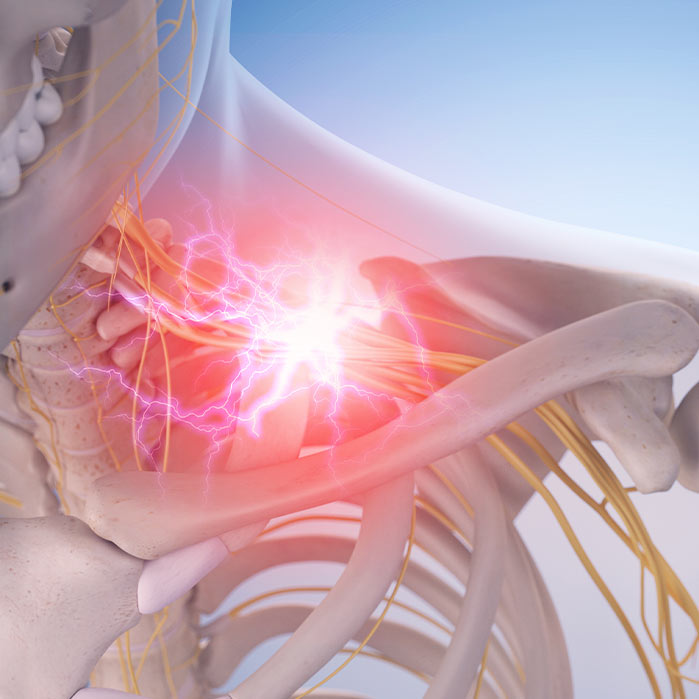 brachial plexus neuritis relief in Monroeville, PA