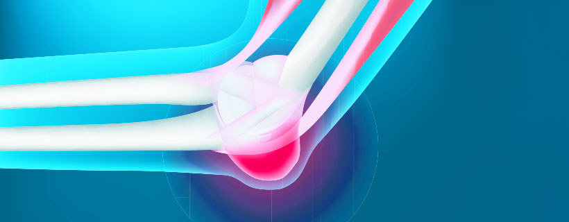patient needing bursitis treatment in Monroeville