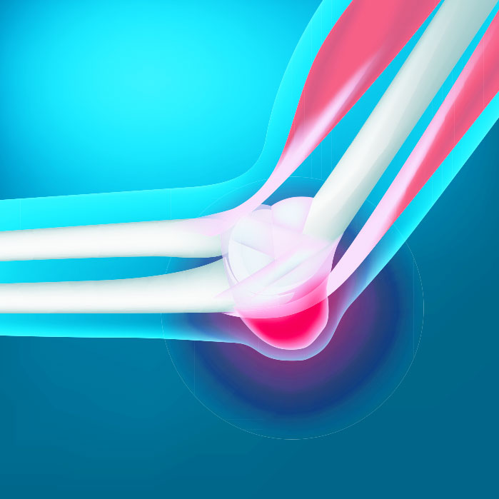 bursitis chiropractor in Monroeville, PA