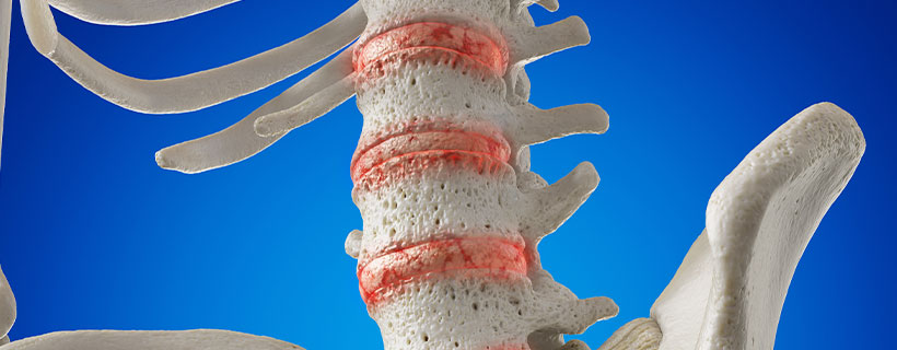 patient needing degenerative disc disease treatment in Monroeville
