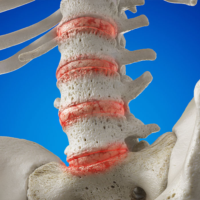 degenerative disc disease treatment in Monroeville, PA