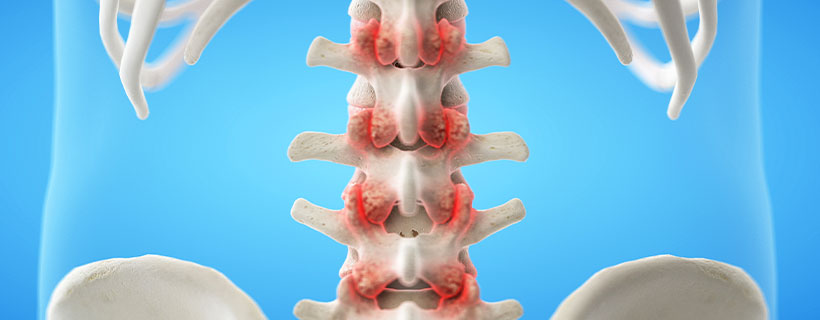 patient needing facet joint syndrome treatment in Monroeville