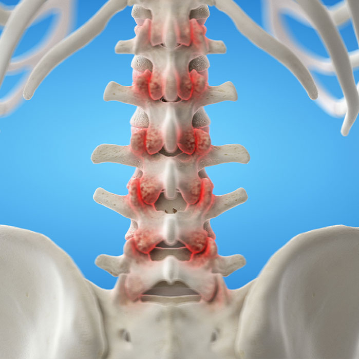 facet joint syndrome treatment in Monroeville, PA