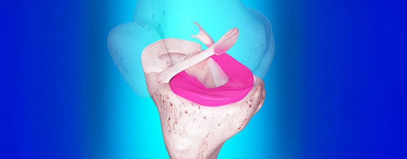 patient needing ligamentitis treatment in Monroeville