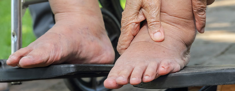patient needing peripheral neuropathy treatment in Monroeville