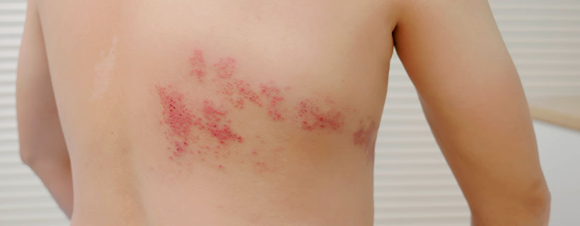 patient needing post herpetic neuralgia treatment in Monroeville