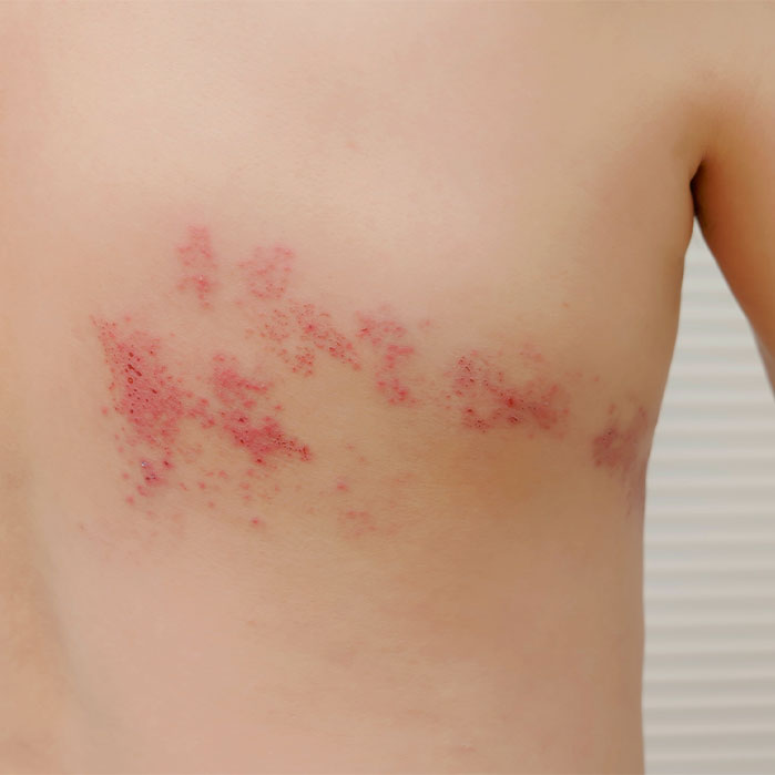 post herpetic neuralgia relief in Monroeville, PA