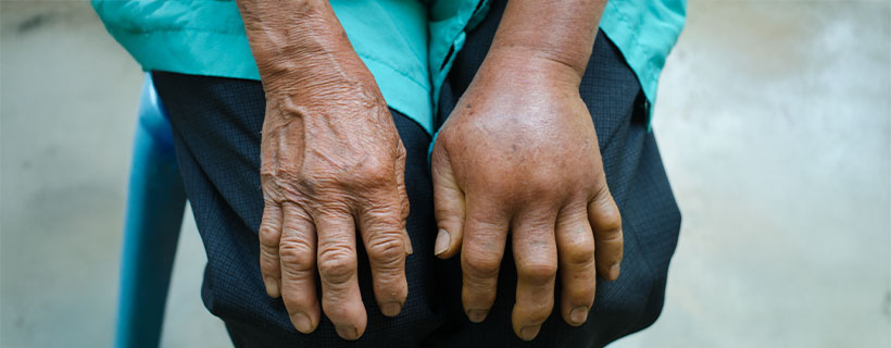 patient needing reflex sympathetic dystrophy treatment in Monroeville