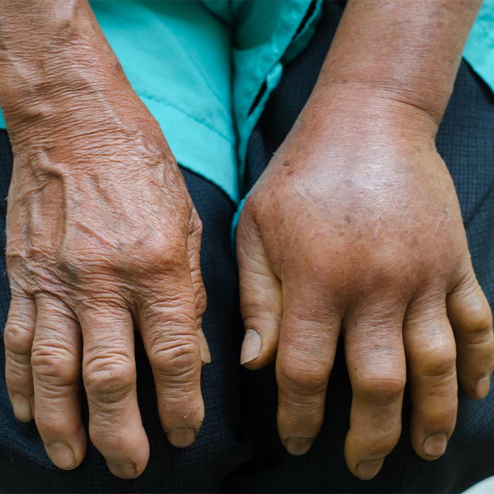 reflex sympathetic dystrophy relief in Monroeville, PA