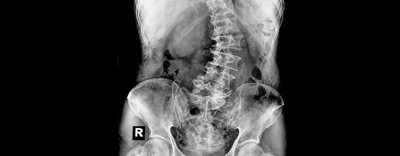 patient needing scoliosis treatment in Monroeville