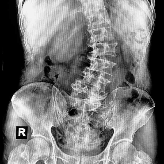 scoliosis chiropractor in Monroeville, PA