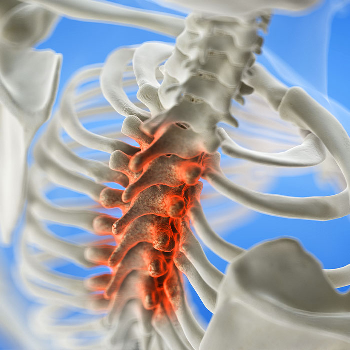 spinal stenosis treatment in Monroeville, PA