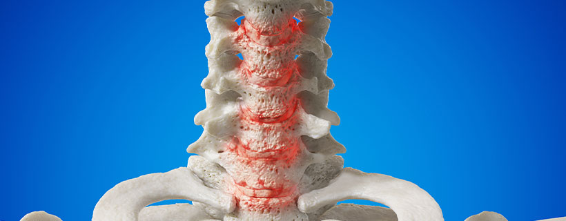 patient needing spondylosis treatment in Monroeville