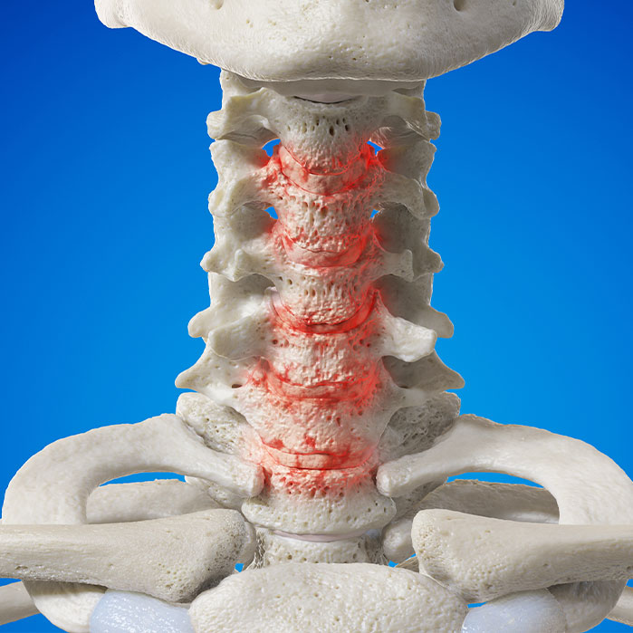 spondylosis treatment in Monroeville, PA
