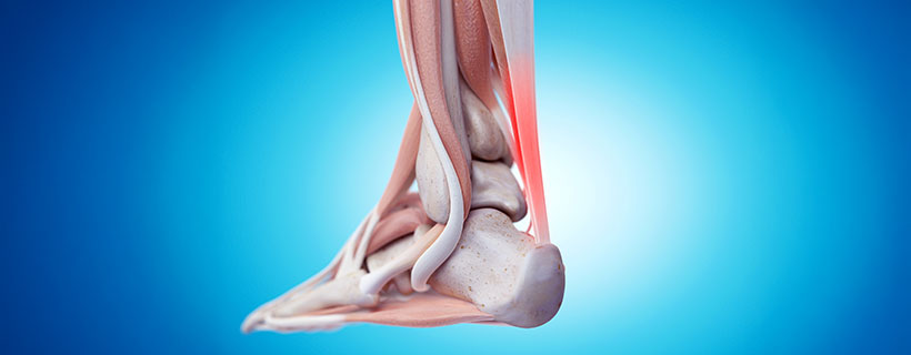 patient needing tendonitis treatment in Monroeville
