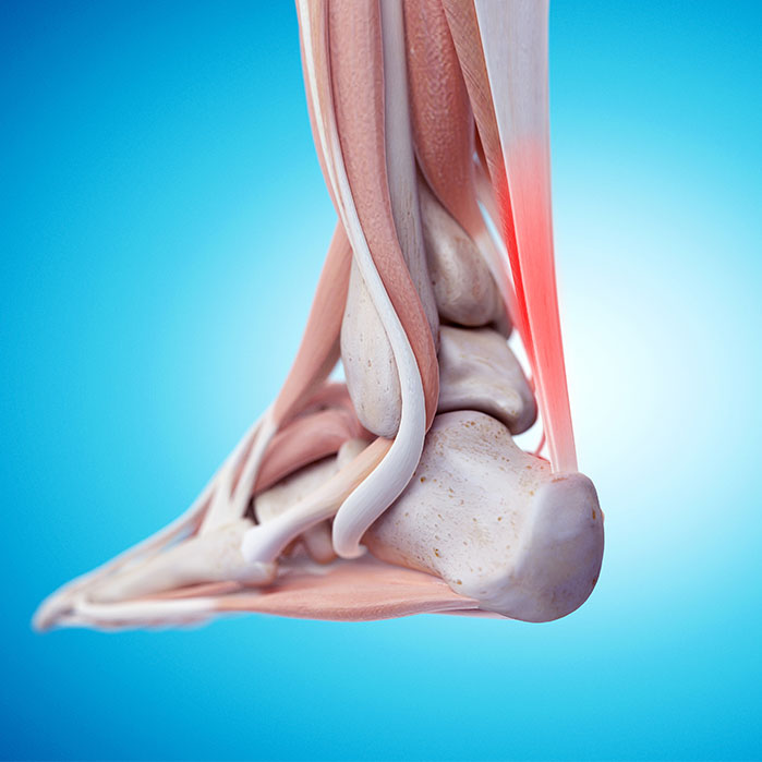 tendonitis chiropractor in Monroeville, PA